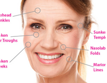 Load image into Gallery viewer, AestheFill - 200mg