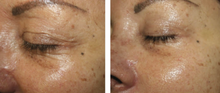 Load image into Gallery viewer, Nucleofill Eyes 0.75%(Soft) - 2ml