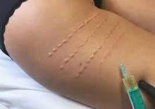 Load image into Gallery viewer, Alidya Solution For Treating Cellulite ( AQUALYX)