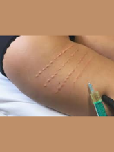 Load image into Gallery viewer, Alidya Solution For Treating Cellulite ( AQUALYX)
