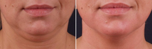 Load image into Gallery viewer, Triada Lipolytic (SLIM+, SMOOTH+, DRAIN+) - 3vials