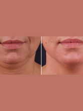 Load image into Gallery viewer, Triada Lipolytic (SLIM+, SMOOTH+, DRAIN+) - 3 vials