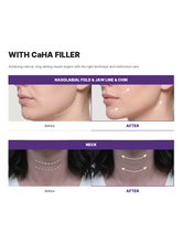 Load image into Gallery viewer, AMI CALX – 1ml, Biostimulator
